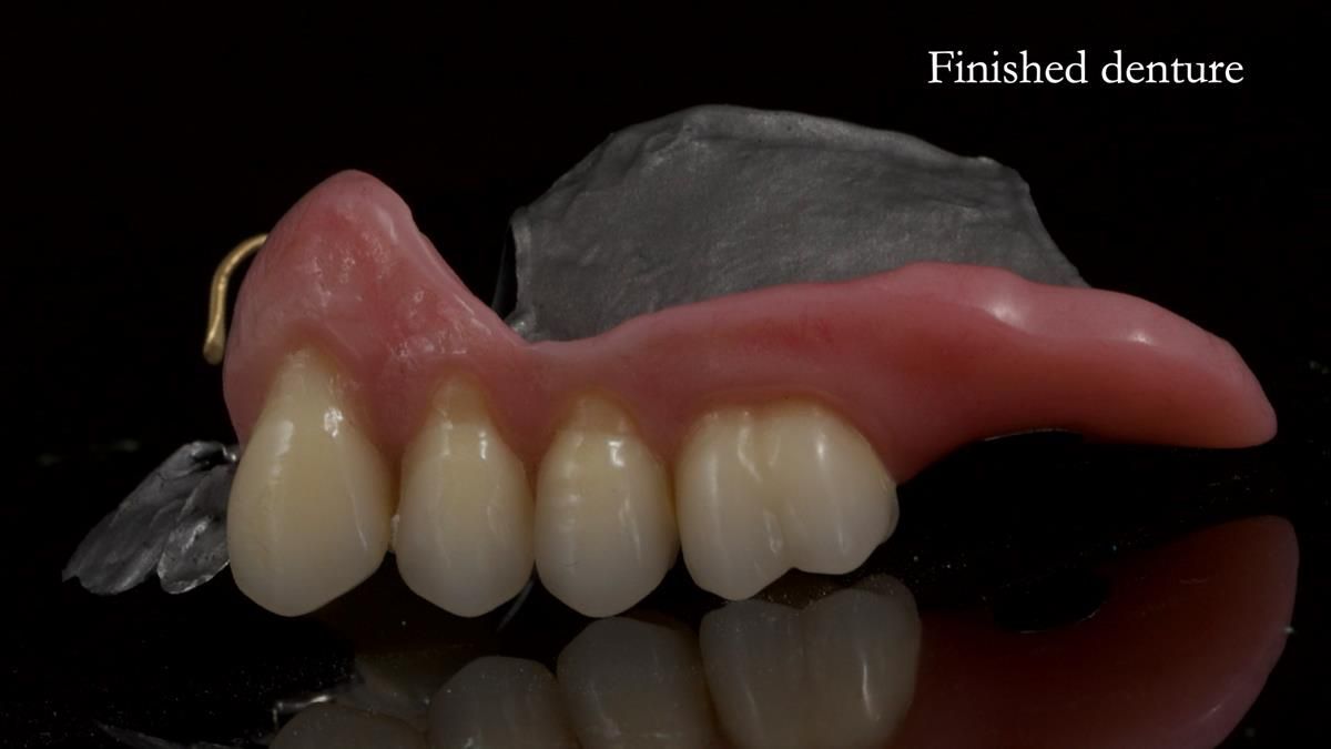 Newsletter 89 – Simon: A Challenging Kennedy Class II Division 1 Upper CoCr Partial Denture with a High Smile Line