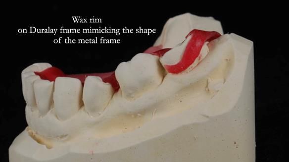 Finlay's Newsletter 61 provision of a lower unilateral free end saddle metal based partial denture for Joyce