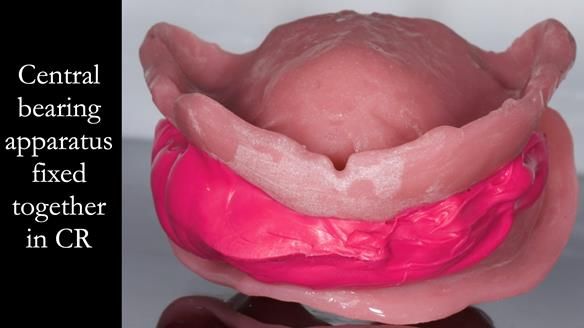 Complete denture Class II div 2 deep overbite Newsletter 39