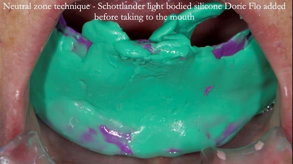 Newsletter 83: Sheila’s Complete Denture Success