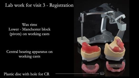 Newsletter 75: Marion’s case - Step-by-step complete denture workflow