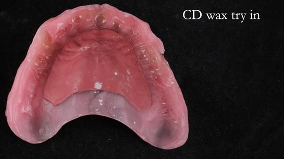Finlay's Newsletter 62 provision of extractions and metal based complete dentures for Rafique