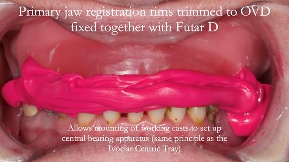 Newsletter 52 Managing Jo’s failing dentition with extractions and Mk 1/Mk 2 complete upper dentures and lower partial dentures FULL PROTOCOL