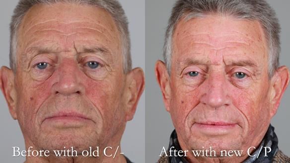 Newsletter 54 case presentation upper complete denture and lower Scandinavian designed hygienic partial denture for David