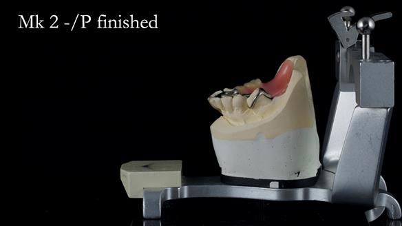 Newsletter 54 case presentation upper complete denture and lower Scandinavian designed hygienic partial denture for David