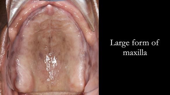 Newsletter 53 showing the making and fitting of ultra life-like dentures for Valena