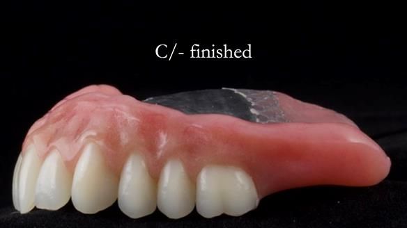 Managing poor implant positioning with complete dentures and Locator attachments - full protocol Newsletter 41