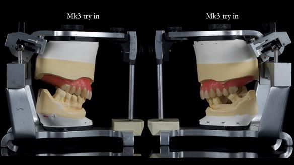 Newsletter 77: Jeremy’s case – immediate complete upper denture