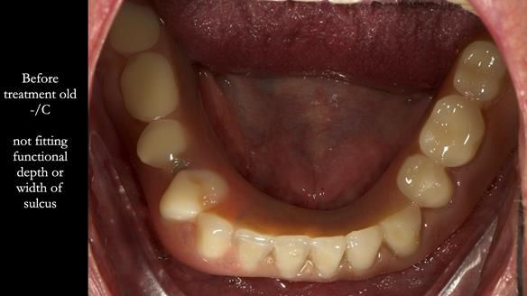 Complete denture Class II div 2 deep overbite Newsletter 39