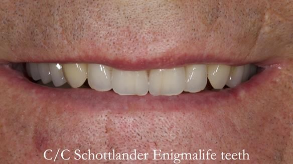 Newsletter 50 Special edition Complete Dentures FULL PROTOCOL