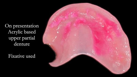 Finlay's Newsletter 58 Gasket upper partial denture for Zoe