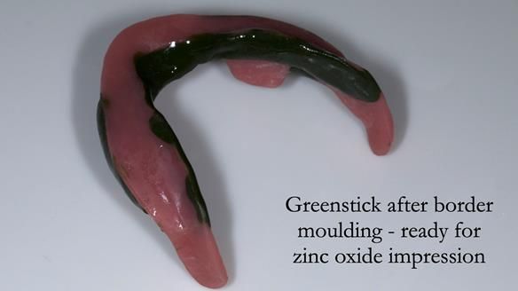 Replacing Madeline’s Complete denture FULL PROTOCOL