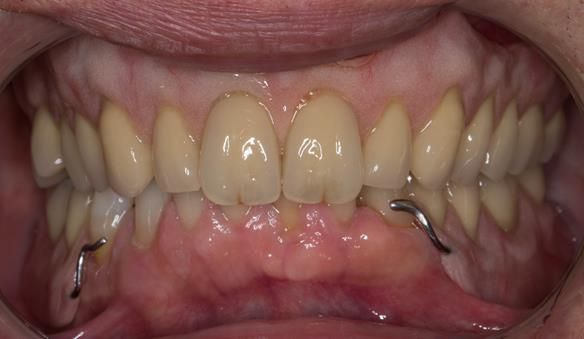 Figure 52 Visit 3 Review 1 post extraction