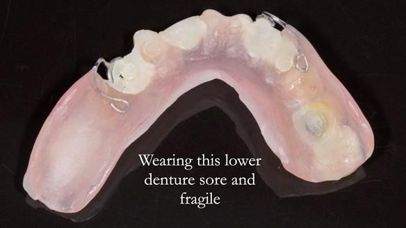 Newsletter 44 - extreme removable prosthodontics – engineering a super-strong and ultra-thin over denture