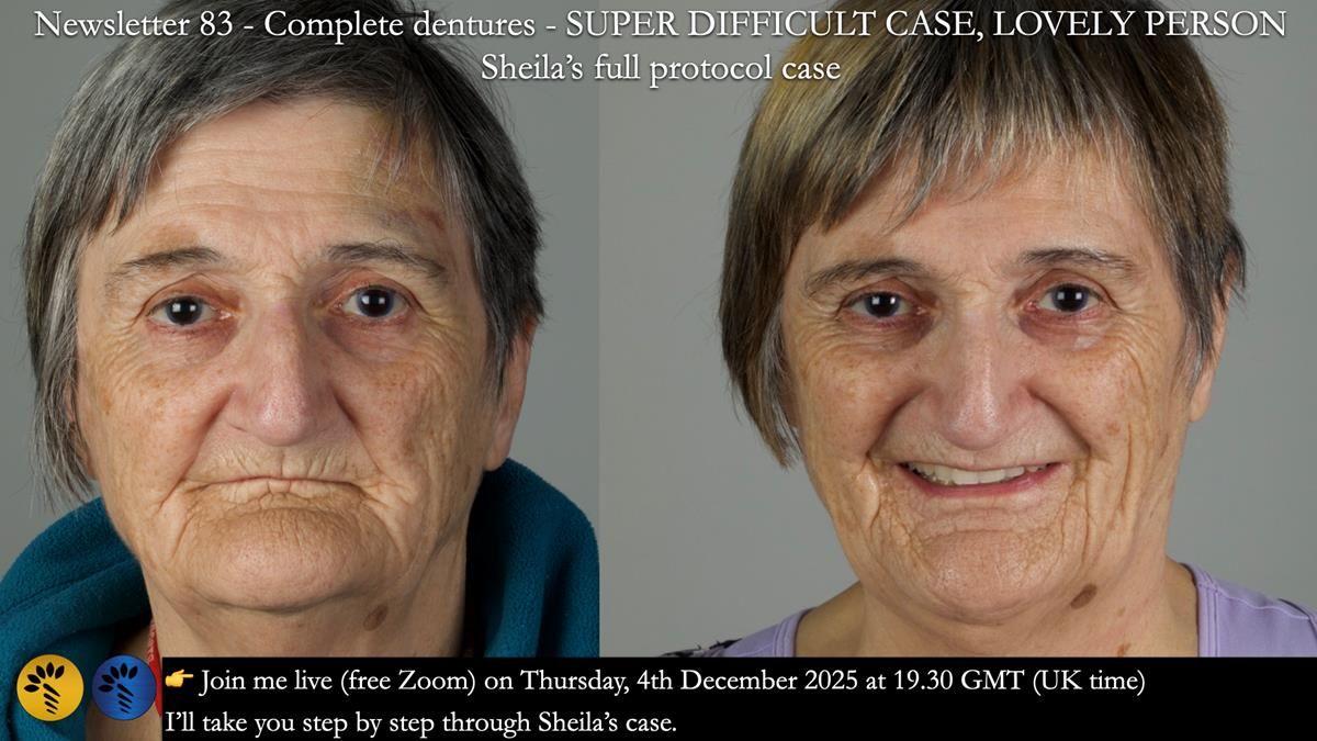Newsletter 83: Sheila’s Complete Denture Success