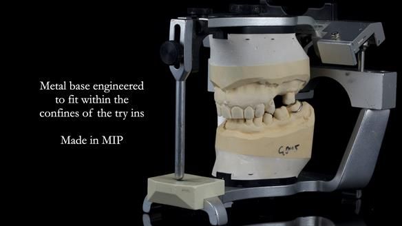 Finlay's Newsletter 61 provision of a lower unilateral free end saddle metal based partial denture for Joyce