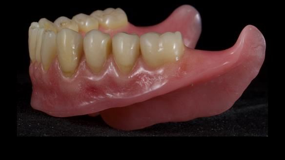 Newsletter 80 - Gordon’s dentures: the one case in 1,000 where my technique failed