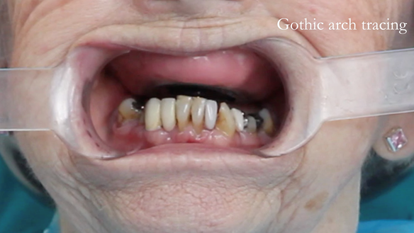 Figure 80 Central bearing apparatus to record centric relation accurately. The mandibular pin is the only point of contact between the maxilla and mandible. The patient performs excursive movements - forwards, backwards and all over