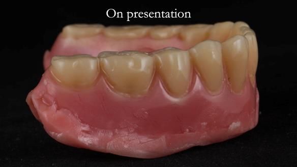 Finlay's Newsletter 62 provision of extractions and metal based complete dentures for Rafique