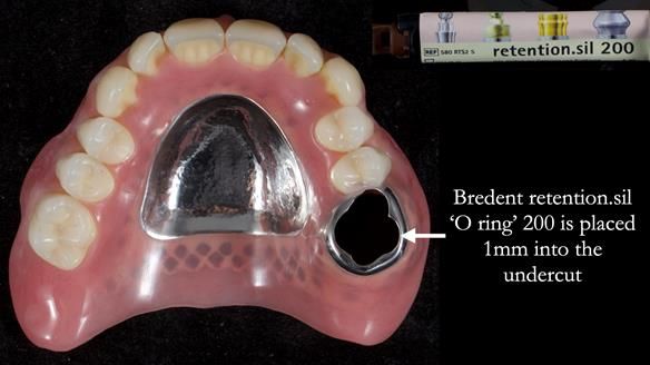 Finlay's Newsletter 58 Gasket upper partial denture for Zoe
