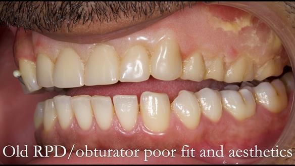 Acrylic based partial denture/obturator had poor, retention and support Obturator section was in poor condition. The Adams clasp were causing inflammation of the gingival margins. The clasp on the UR3 was visible resulting in poor appearance. Reduced lip