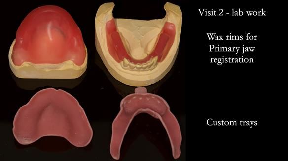 Newsletter 52 Managing Jo’s failing dentition with extractions and Mk 1/Mk 2 complete upper dentures and lower partial dentures FULL PROTOCOL