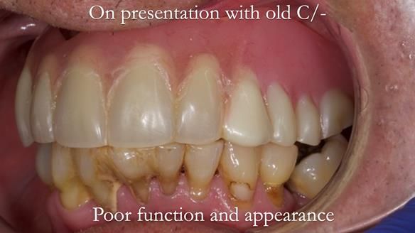 Newsletter 54 case presentation upper complete denture and lower Scandinavian designed hygienic partial denture for David
