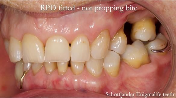 Finlay's Newsletter 61 provision of a lower unilateral free end saddle metal based partial denture for Joyce