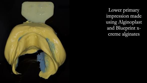 Newsletter 83: Sheila’s Complete Denture Success