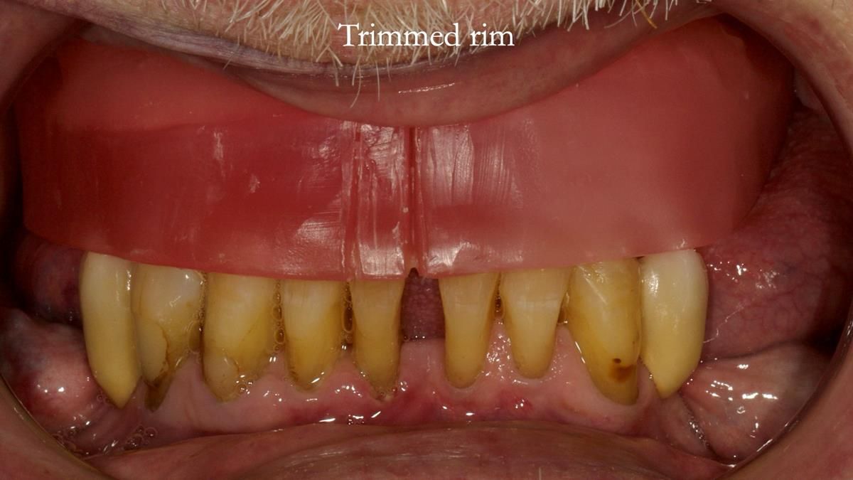 Newsletter 87 – Father Peter: A Partial Denture that needed Minor Miracle