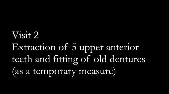 Finlay's Newsletter 62 provision of extractions and metal based complete dentures for Rafique