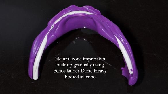 Newsletter 83: Sheila’s Complete Denture Success