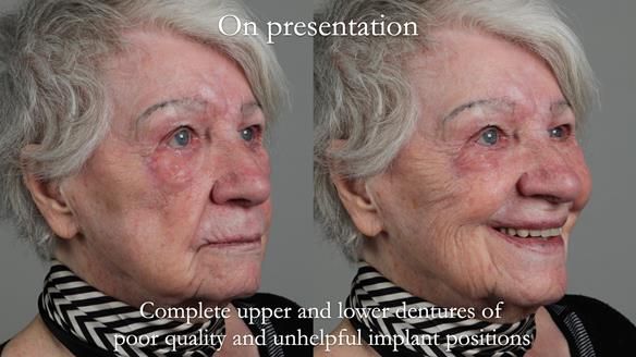 Newsletter 65 Marisa Provision of Complete Dentures on badly placed implants