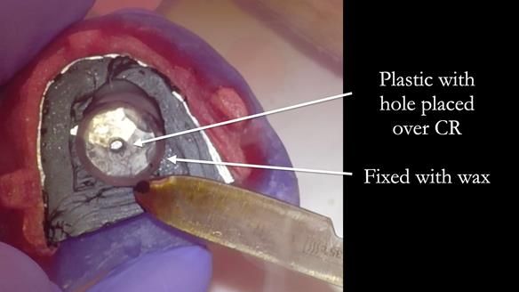 Newsletter 83: Sheila’s Complete Denture Success