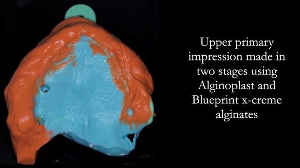 Solving Linda’s Failed “All on 4” implant bridges - full protocol Newsletter 42