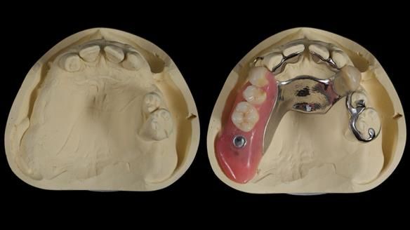 Newsletter 86 Peter the Architect — precision removable partial dentures case study