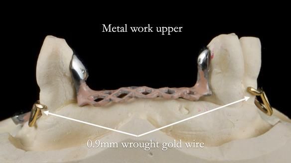 Finlay's Newsletter 59 Ultra hard partial dentures made for Gill