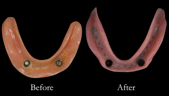 Figure 27 Before and after changes in shape of the denture fitting surfaces. Optimal extensions from border moulding. New denture metal reinforced too