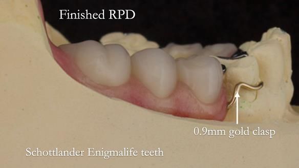 Eileen's transformation with upper and lower RPDs of Scandinavian hygienic design FULL PROTOCOL