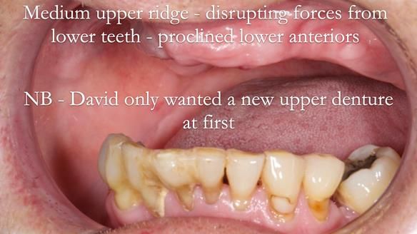 Newsletter 54 case presentation upper complete denture and lower Scandinavian designed hygienic partial denture for David