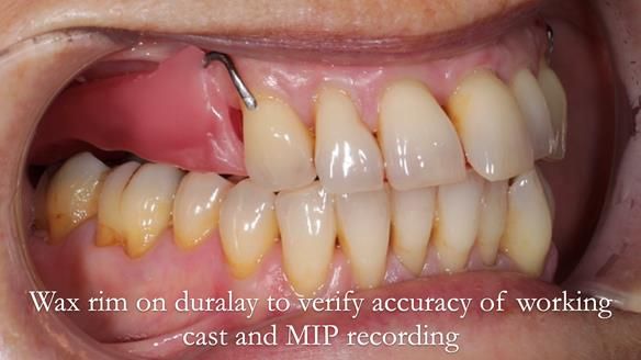 Newsletter 56 showing the making and fitting of a bilateral free end saddle upper removable partial denture (RPD) for patient with pemphigus