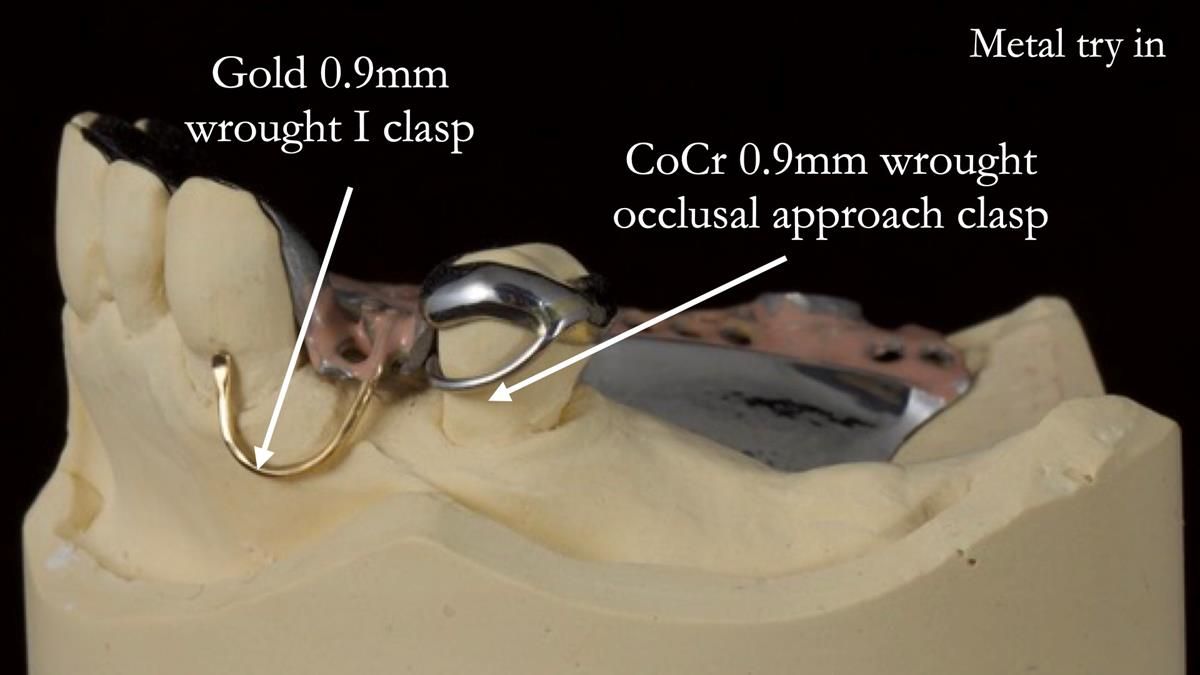 Newsletter 89 – Simon: A Challenging Kennedy Class II Division 1 Upper CoCr Partial Denture with a High Smile Line
