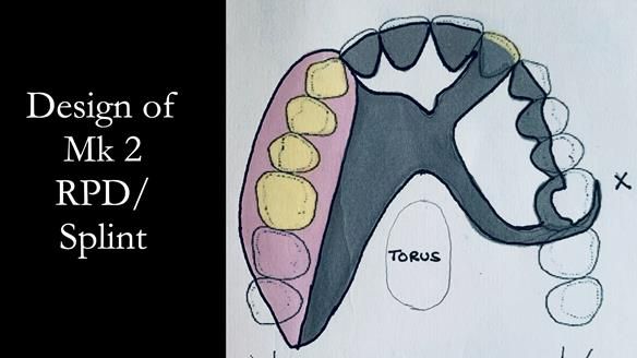 Newsletter 51 Managing Anne’s failing dentition with distal extension base RPD/Splint FULL PROTOCOL