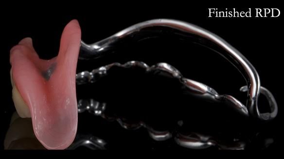 Finlay's Newsletter 61 provision of a lower unilateral free end saddle metal based partial denture for Joyce