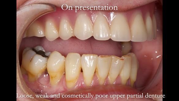 Finlay's Newsletter 58 Gasket upper partial denture for Zoe