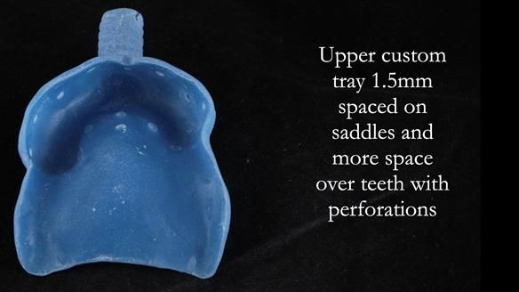 Newsletter 56 showing the making and fitting of a bilateral free end saddle upper removable partial denture (RPD) for patient with pemphigus