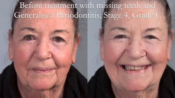 Finlay's Case Study Newsletter 40 - Immediate Mk 1 RPD to Definitive Mk 2 RPD - full protocol
