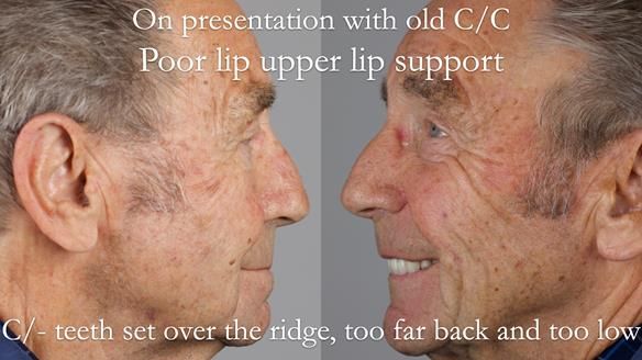 Newsletter 50 Special edition Complete Dentures FULL PROTOCOL