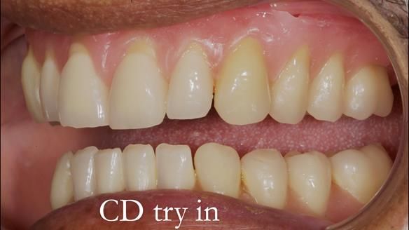 Finlay's Newsletter 62 provision of extractions and metal based complete dentures for Rafique