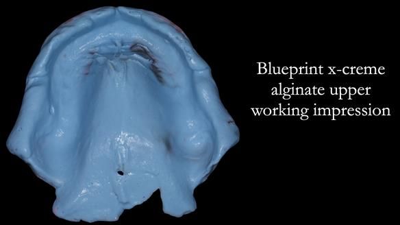 Newsletter 50 Special edition Complete Dentures FULL PROTOCOL